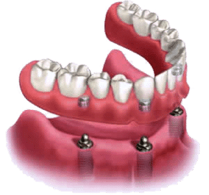 Implant Supported Denture